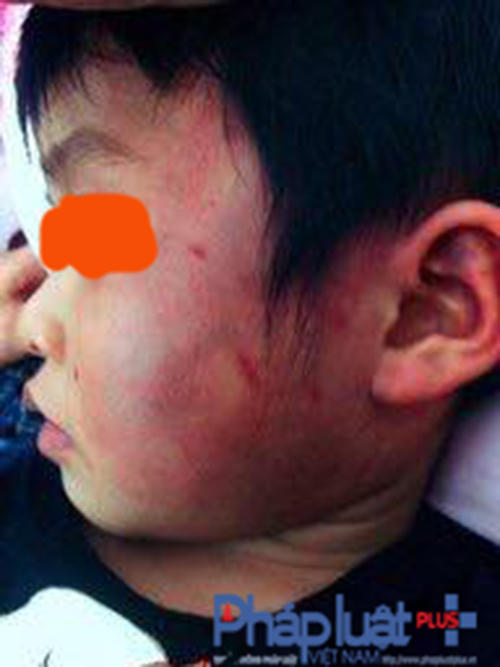 Những vết thâm tím xuất hiện dày đặc trên mặt cháu L.T.D.
