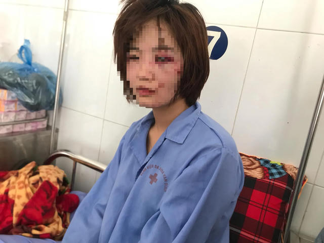 Chị H. với những thương tích trên khuôn mặt sau khi bị nhóm đối tượng nam giới hành hung (Ảnh: CTV).