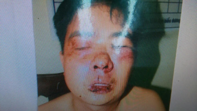 Anh Trần Đức Lợi bị những đối tượng tại nhà Thành Đốm hành hung khiến khuôn mặt bị biến dạng nghiêm trọng.