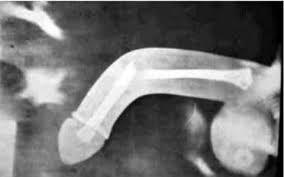 Thông tin từ Bệnh viện Nhân dân 115 TP HCM, cuối tháng 11, một nam bệnh nhân đã nhập viện trong tình trạng “cậu nhỏ” sưng đau và bầm tím toàn bộ. Ảnh minh hoạ: Internet