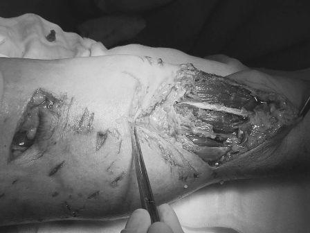 Sau 2 giờ vi phẫu các bác sĩ đã nối thành công gân, cơ và dây thần kinh. (Ảnh: BS Xuân Anh).