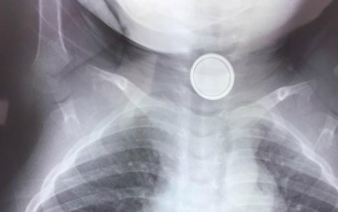 Cục pin được phát hiện chặn ngang thực quản cháu bé. (Ảnh bệnh viện cung cấp).