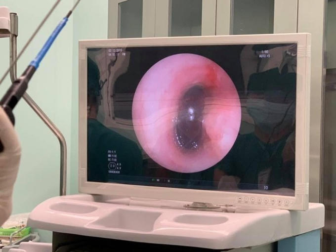 Dị vật có màu đen, hình elip, kích thước khoảng 2cm, trông giống hạt sapôchê. Ảnh: Lao Động