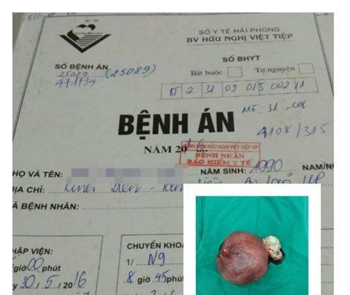 Hình ảnh khối u được cắt bỏ. (Ảnh: Dân Việt)