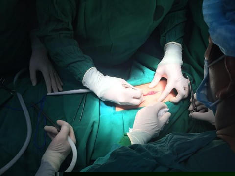 Đội ngũ bác sĩ phẫu thuật bé gái 5 tuổi để lấy vật thể trong bao tử.