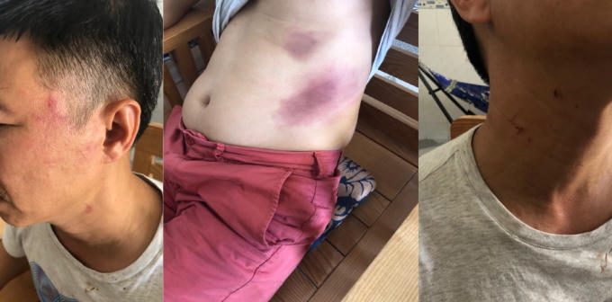 Các vết thương trên người ông H.