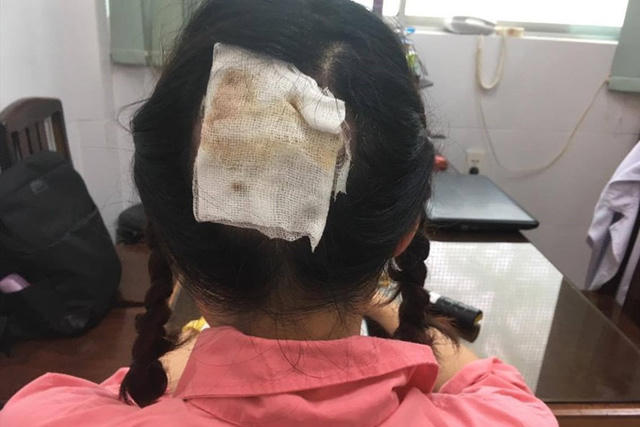 Vùng da đầu bị tổn thương nặng của bệnh nhân sau khi uốn tóc setting. Ảnh: M.P