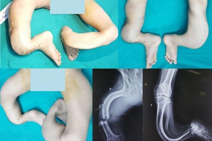 Đôi chân của bệnh nhân trước khi được phẫu thuật