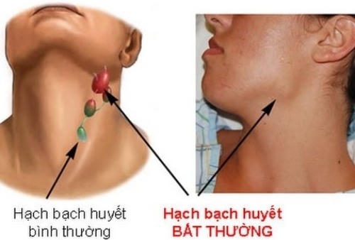 Hạch bạch huyết ở cổ sưng lên là một trong những dấu hiệu của ung thư máu. Ảnh: News.