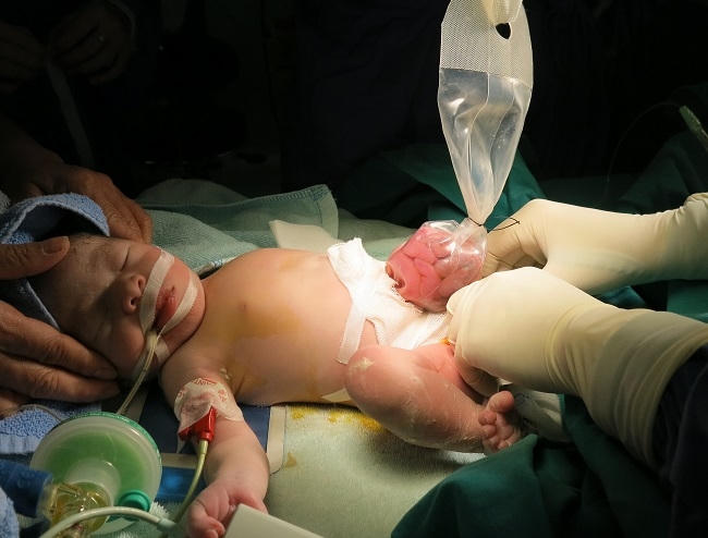 K&iacute;p phẫu thuật đ&atilde; tiến h&agrave;nh đặt t&uacute;i silo để dần dần c&aacute;c tạng của b&eacute; chui dần v&agrave;o trong ổ bụng.