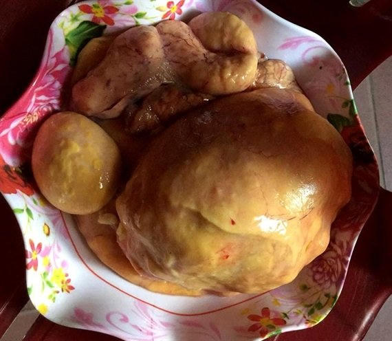 Khối dị vật màu vàng có trọng lượng 0,8 kg
