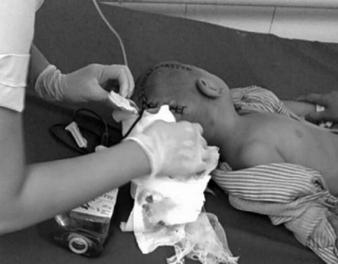 Cháu Huy phải mổ gấp để giữ tính mạng (Ảnh: GĐCC)
