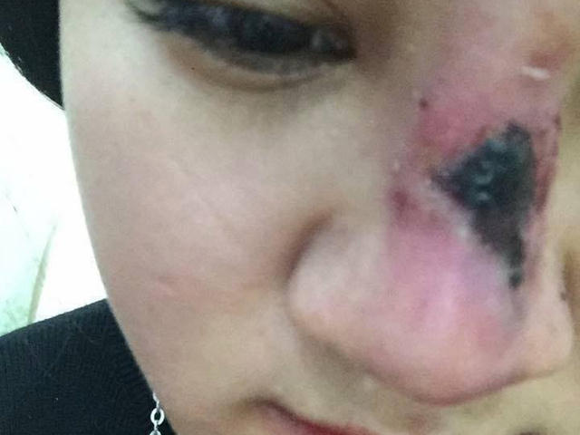 Nạn nhân tố "nữ bác sĩ" phẫu thuật làm lòi xương mũi. Ảnh: Dân Việt