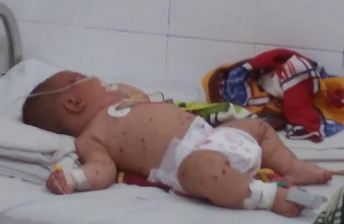 Viêm não mô cầu có thể gây tử vong trong 24h sau khi phát hiện những triệu chứng như sốt cao, đau đầu, buồn nôn....(ảnh: internet).