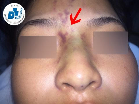 Hình ảnh bệnh nhân bị biến chứng tắc mạch, mất thị lực sau tiêm filler tại thẩm mỹ viện đến khám và điều trị tại Bệnh viện Da liễu Trung ương ngày 22/10/2019. Ảnh: BV Da liễu TW