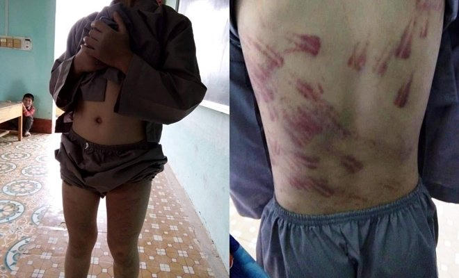 Toàn thân em D. chi chít những vết thâm cho sư trụ trì Thích Đàm Trang dùng roi mây đánh.