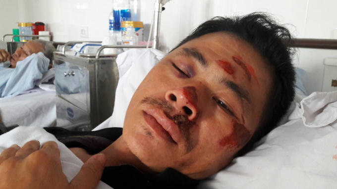 Khuôn mặt anh Hùng nhiều thương tích sau khi bị đánh đập.