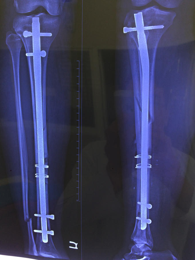 Bản X- quang sau phẫu thuật.