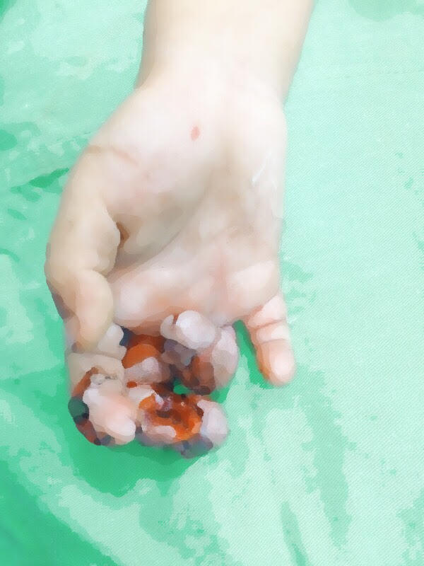 Bệnh nhi bị tổn thương nặng ở tay do máy ép mía. Ảnh: BVCC