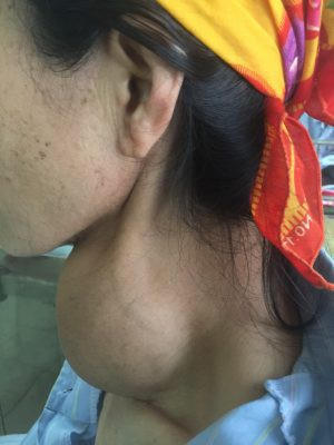 Khối u bướu giáp của bệnh nhân.