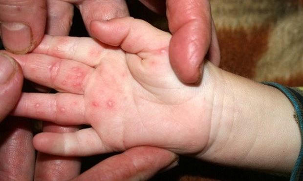 Trẻ có thể mắc tay chân miệng nhiều lần. Ảnh: minh họa