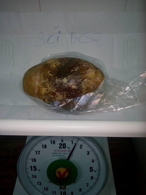 Hình ảnh viên sỏi bàng quang được lấy ra từ người bệnh nhân. (Công An Nhân Dân)