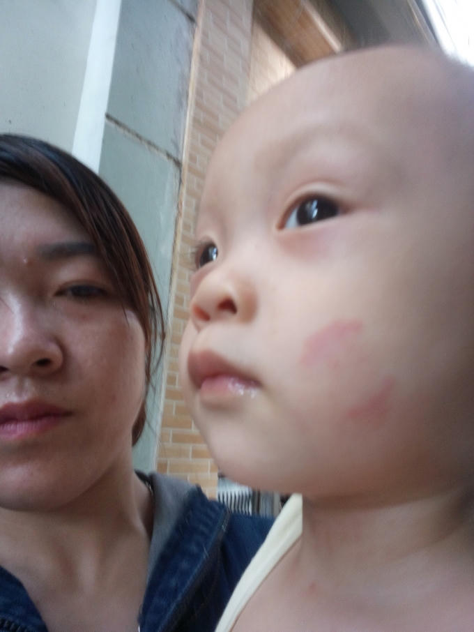 Một trong những vết cắn được chụp lại.