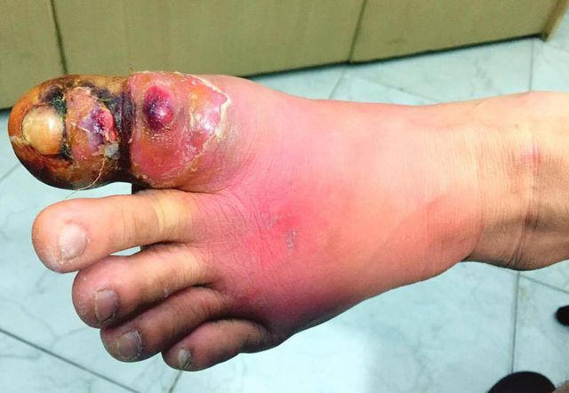 Bài chân bị nhiễm trùng vì thói quen lấy da thừa quanh móng chân và cắt khóe móng chân (ảnh BSCC)