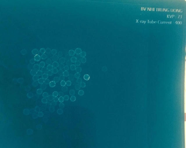 Hình ảnh phim chụp Xquang viên thuốc trên phim chụp X-quang. Ảnh: BV cung cấp