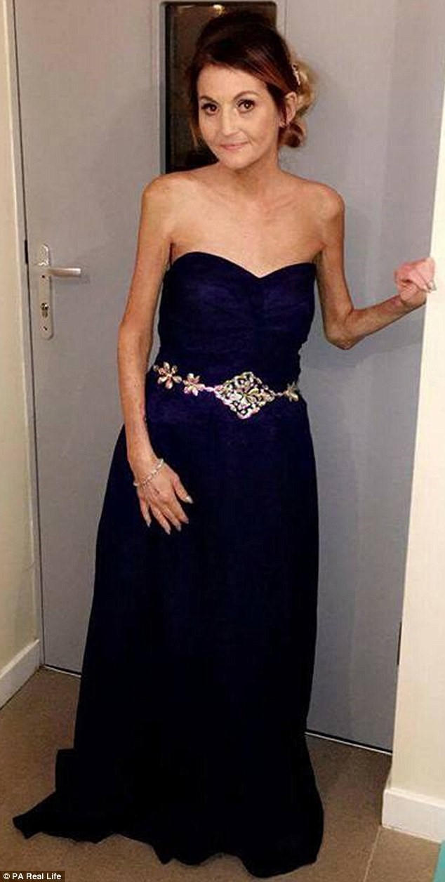 Lorraine Burnet không bao giờ tin rằng mình bị mất một chân chỉ vì đeo giày cao gót. Ảnh: PA Real Life.