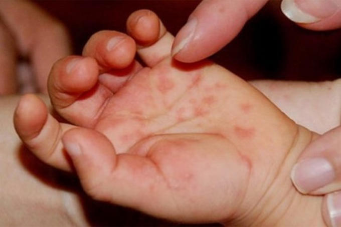 Hiện nay chưa có vacccine phòng bệnh và thuốc đặc trị bệnh tay chân miệng.