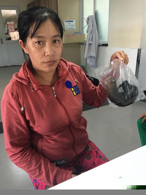 Bà Thanh mẹ cháu bé với số tóc lấy ra từ bao tử của con gái.