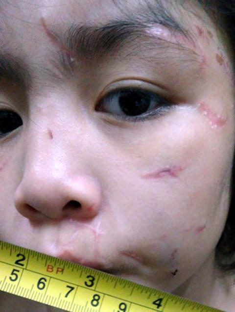 Những vết sẹo trên mặt cháu bé.