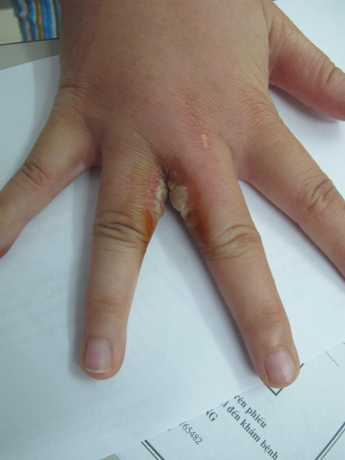 Một bệnh nhân bị viêm da do tiếp xúc với kiến ba khoang. Ảnh: BVCC