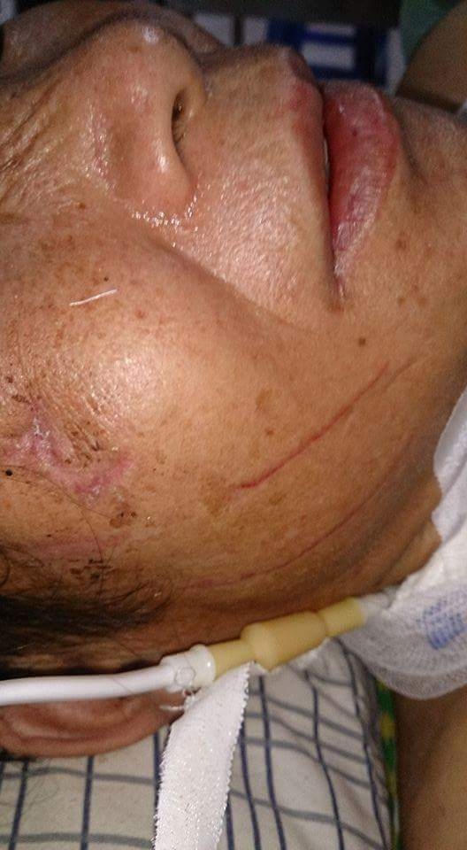 Nạn nhân nhập viện trong tình trạng toàn thân đều bị thương nặng, bị chảy máu não trong và ngoài.