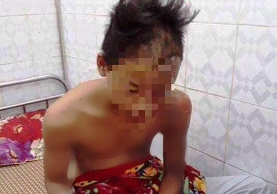 Em T.Đ.T. bị sét đánh cháy xém vùng mặt trái và cánh tay trái nhưng may mắn thoát chết.