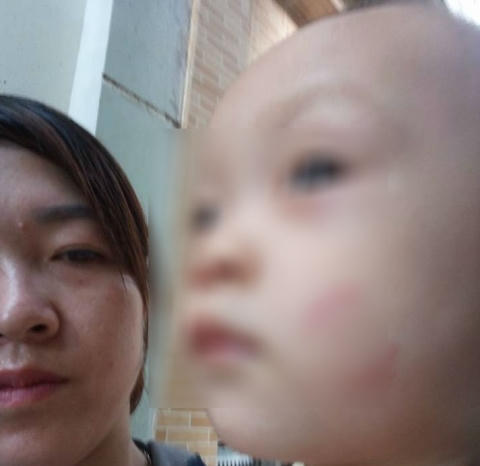 Bé trai bị tím mặt vì bị cắn.