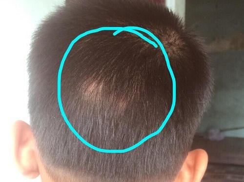 Phần đầu nhiều ngày bị bầm tím của An.
