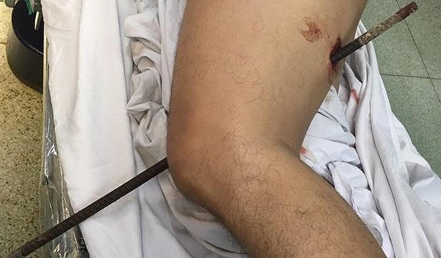 Ngã từ độ cao 5 mét xuống đất, nam thanh niên bị thanh sắt đâm xuyên đùi