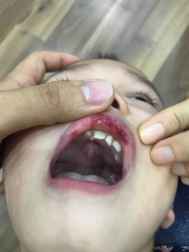 Bé 3 tuổi bị cô giáo mầm non tát hằn cả bàn tay và tụ máu môi