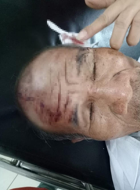 Người cha bị chảy máu đầu sau khi bị con trai đánh.