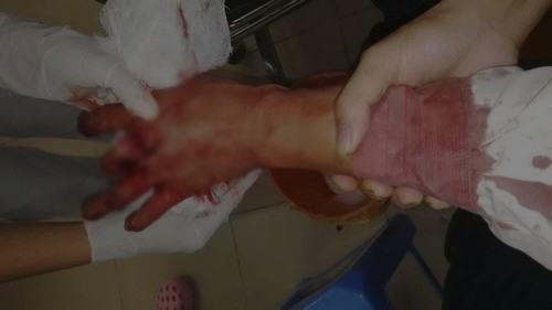 Cơ thể ông Nguyễn Đoàn Bộ chịu tổn thương 12% sau hành vi do ông Nguyễn Vinh Tâm gây ra cho nạn nhân.