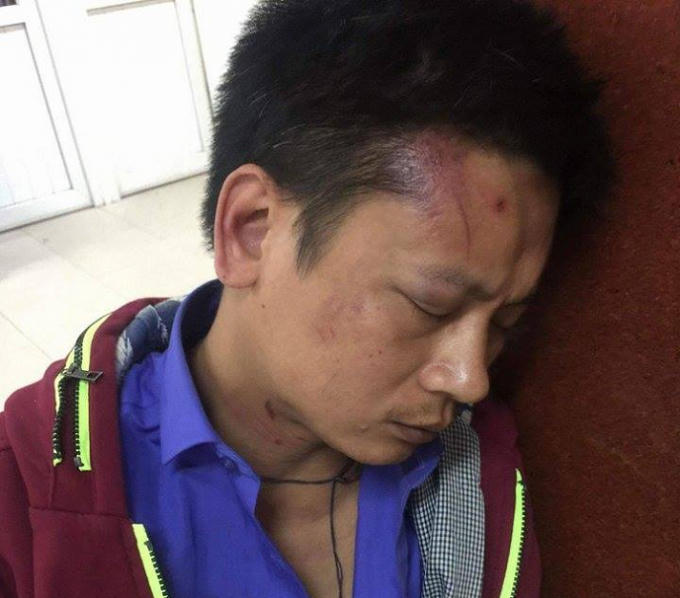 Anh P. bị thâm tím mặt do bị bảo vệ hành hung.