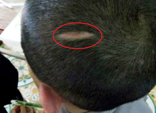 Trên đầu em D. có những vết sẹo lớn, nghi vấn do sư thầy đánh