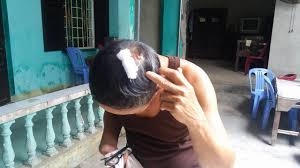 Vết thương trên đầu của ông Lộc.
