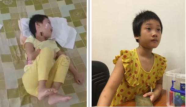 Bé Hà Gia Linh trước khi ghép chỉ sống thực vật, sau 3 lần ghép tế bào gốc đã tiến bộ vượt bậc, có thể đi lại bình thường, tự phục vụ, cải thiện nhận thức rõ rệt