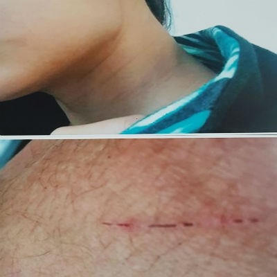 Những vết chấn thương bầm tím trên cổ, trầy xướt hằn dấu bị tấn công trên người nạn nhân. Ảnh do gia đình nạn nhân cung cấp.