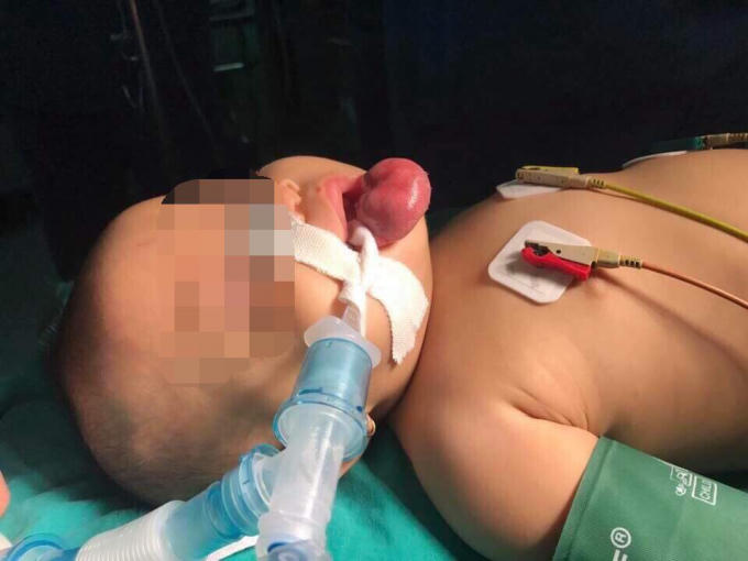 Hình ảnh bướu môi của bé trước khi phẫu thuật.