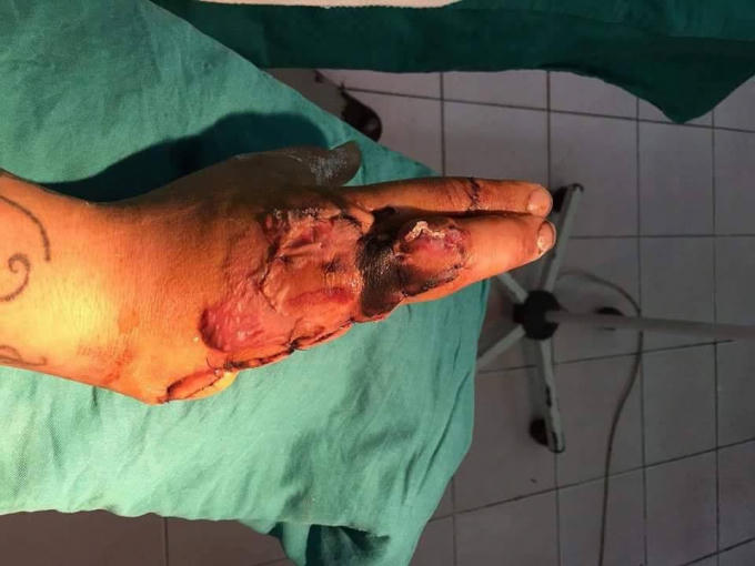 Nạn nhân được đưa đi cấp cứu với bàn tay phải giờ trở thành vô dụng.
