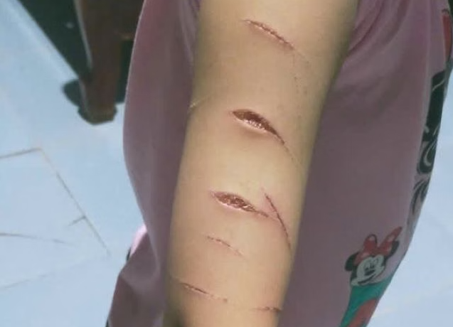 Vết thương trên tay em N.